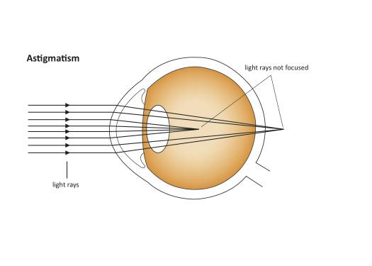 Astigmatism-Correcting Cataract Surgery Information