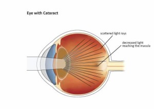 Introduction to Intraocular Lenses | Cataract Surgery Information