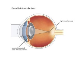 Introduction to Intraocular Lenses | Cataract Surgery Information